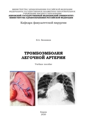Тромбоэмболия легочной артерии
