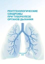 Рентгенологические синдромы при туберкулезе органов дыхания