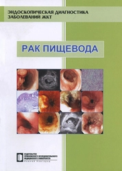 Рак пищевода