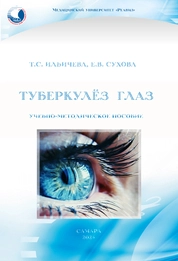 Туберкулёз глаз